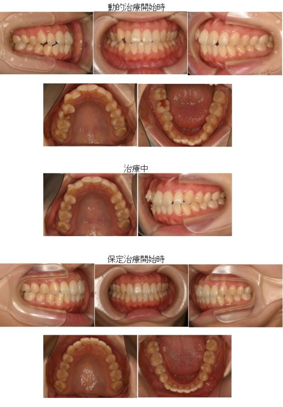 治療症例集 ふくの歯科 矯正歯科 小田急小田原駅7分 土曜 日曜も診療 駐車場完備
